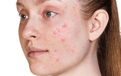 pimple skin