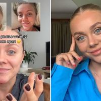 Aussie warns against popping pimples after getting a nasty infection