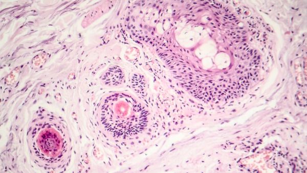 What is basal cell carcinoma, the skin cancer Biden just had