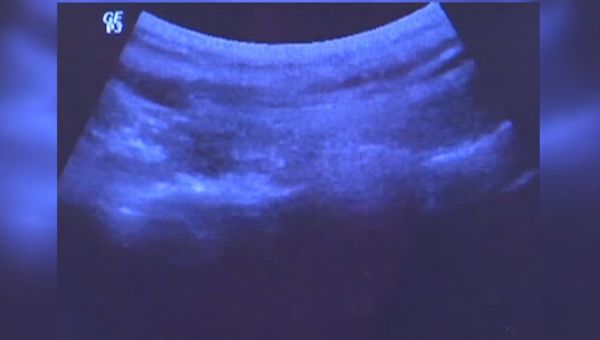 S.C. Supreme Court sides with state on abortion ban around 6 weeks