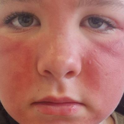 Mum’s urgent warning after claiming daughter’s skin peeled off from Primark cleanser – Yorkshire Live
