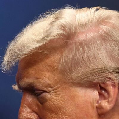 What is going on under Trump’s ‘Doubtfire’ hair after ‘scalp reduction’ claims
