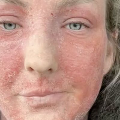 Birmingham woman says treatment left her ‘looking like a burnt hamster’