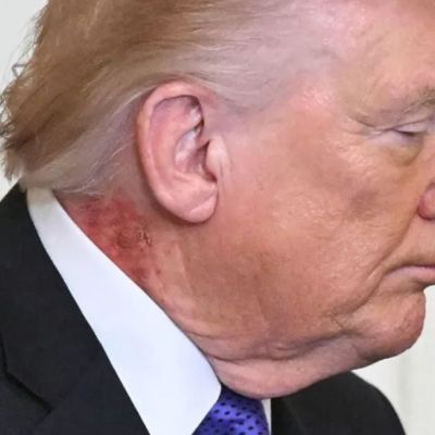 From aspirin to cream: White House links President Trump’s neck rash to ‘preventative’ skin treatment