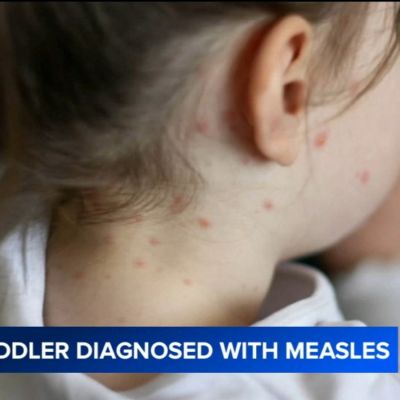 Riverside toddler diagnosed with measles despite vaccination, mother now warning parents
