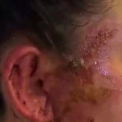 ‘Didn’t take it seriously’: Victim recovering after being run over by Volusia beach patrol car
