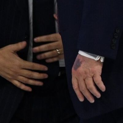 Trumps doctor claims hand bruising caused by frequent handshaking