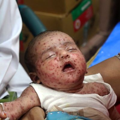 World’s worst measles outbreak a ‘warning’ to other nations