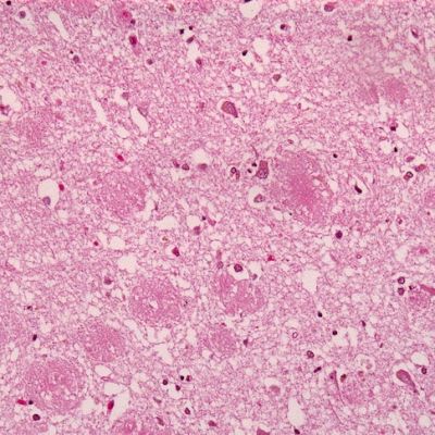 Test that could identify Alzheimer’s signs 20 years earlier greenlit for trials