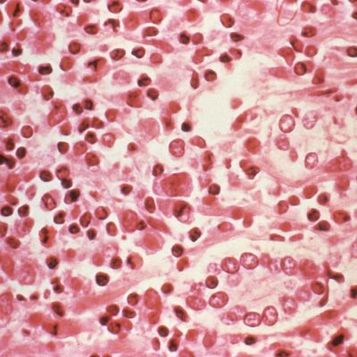 What is the hantavirus that killed 3 cruise ship passengers?