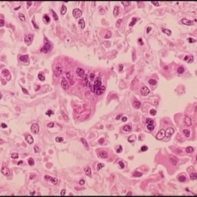 Measles in Fresno County could have led to Madera County exposure