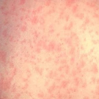 Ohio kindergarten vaccination rates drop amid measles outbreak concerns