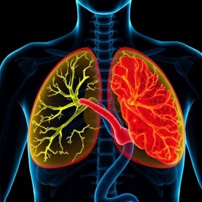 Exome Sequencing Uncovers Inflammatory Breast Cancer Insights