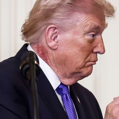White House explain what is causing large scabbing rash on Trump’s neck