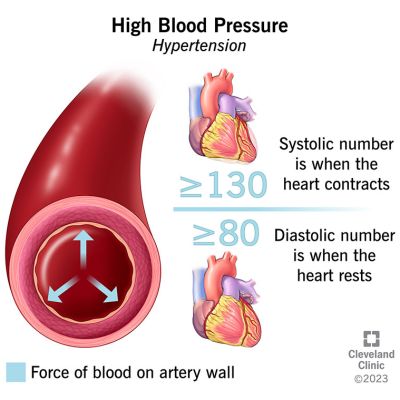 Uncontrolled high blood pressure puts over a billion people at risk