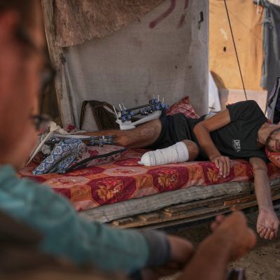 Gaza amputees struggle to rebuild lives as the enclave faces shortages of prosthetic limbs