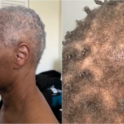 Actress sues theater company, alleging racial discrimination led to hair loss