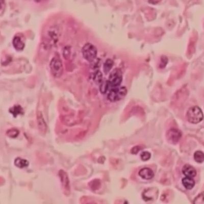 Texas measles outbreak grows to 146 cases, largest in decades