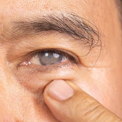 Air Pollution Increases Risk Of Eye Infection, Other Ocular Problems, Say Doctors Img