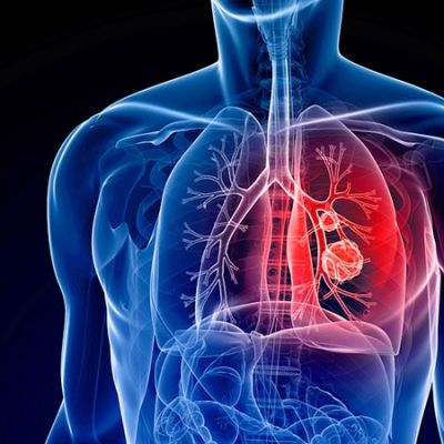 Many Hurdles Exist to Treating Lung Cancer With CAR T Cells
