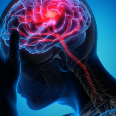 How artificial intelligence is changing health care in treating stroke victims