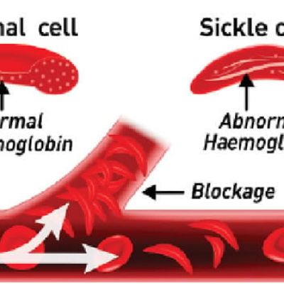 Sickle Cell: Foundation seeks transplant subsidy