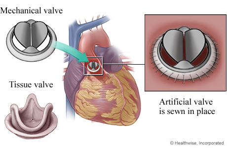 Mechanical valve and tissue valve, showing mechanical valve in heart, with detail of valve sewn in place Mechanical valve and tissue valve, showing mechanical valve in heart, with detail of valve sewn in place
