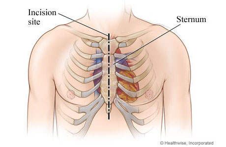 Chest incision site down the middle of the sternum from top to bottom of sternum Chest incision site down the middle of the sternum from top to bottom of sternum