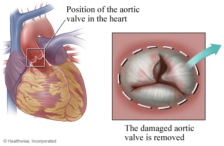 Location of aortic valve in the heart with detail of damaged valve Location of aortic valve in the heart with detail of damaged valve