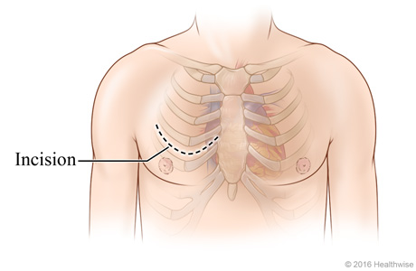 Chest incision site across chest between two ribs Chest incision site across chest between two ribs