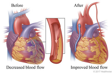 Decreased blood flow caused by narrowed or blocked artery before surgery and normal blood flow after surgery Decreased blood flow caused by narrowed or blocked artery before surgery and normal blood flow after surgery
