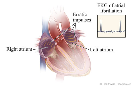 How atrial fibrillation happens How atrial fibrillation happens
