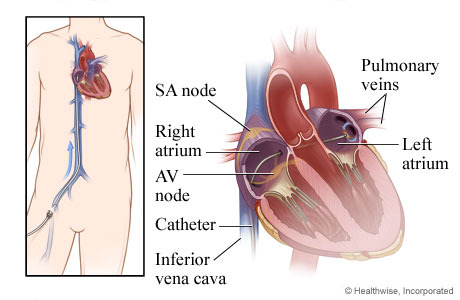 How a catheter is inserted through a vein to the heart How a catheter is inserted through a vein to the heart