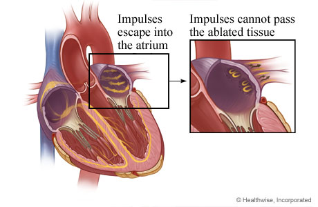 How scar tissue from ablation stops electrical impulses How scar tissue from ablation stops electrical impulses