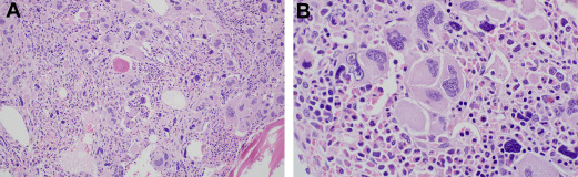 COMPREHENSIVE APPROACH TO MYELOPHTHISIC ANEMIA: ETIOLOGY, DIAGNOSIS, MANAGEMENT