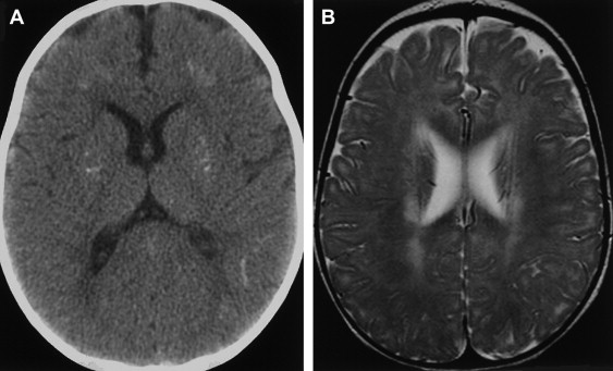 PROGRESSIVE RUBELLA PANENCEPHALITIS: AN IN-DEPTH OVERVIEW OF ITS PATHOGENESIS, DIAGNOSIS, AND MANAGEMENT