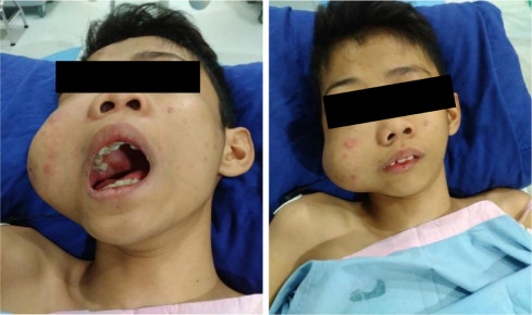 EXPERT INSIGHTS INTO JUVENILE NASOPHARYNGEAL ANGIOFIBROMA: A DETAILED CLINICAL REVIEW