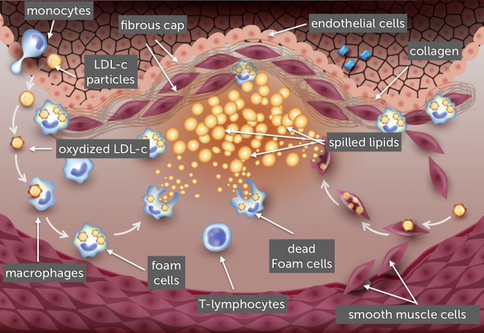 HOW ATHEROSCLEROSIS AFFECTS YOUR HEART HEALTH