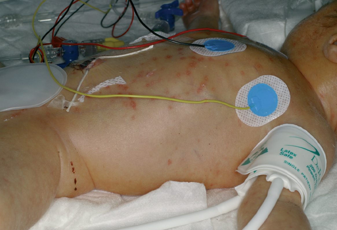 SPOTTING NEONATAL LISTERIOSIS EARLY SIGNS