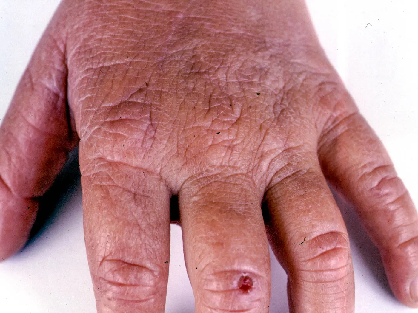 COMPREHENSIVE UNDERSTANDING OF ERYTHROPOIETIC PROTOPORPHYRIA AND X-LINKED PROTOPORPHYRIA