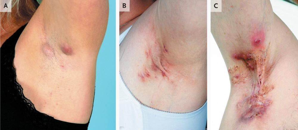 UNDERSTANDING HIDRADENITIS SUPPURATIVA: PATHOPHYSIOLOGY AND CLINICAL MANIFESTATIONS