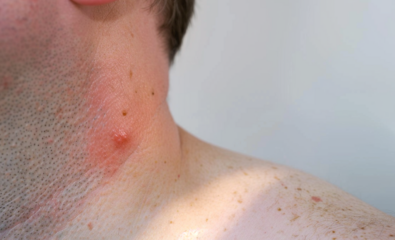 ESSENTIAL INSIGHTS INTO ATYPICAL FIBROXANTHOMA: THE COMPLETE MANUAL