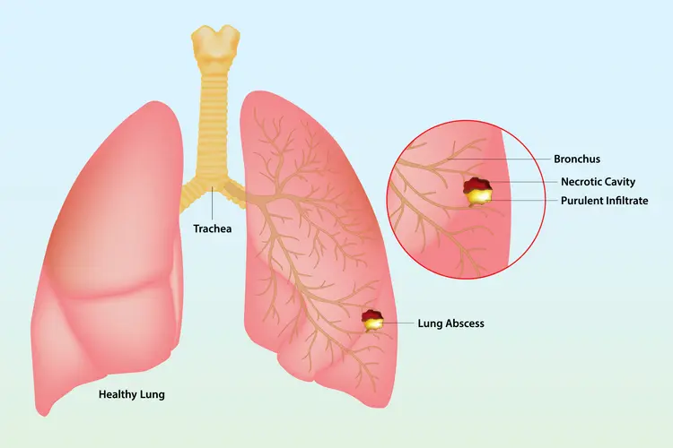 LUNG ABSCESS: EVERYTHING YOU NEED TO KNOW ABOUT THIS PULMONARY CONDITION