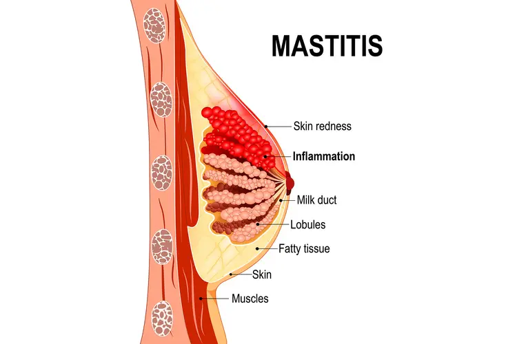 MASTITIS IN OBSTETRICS: CAUSES, SYMPTOMS, AND TREATMENT OPTIONS