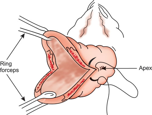 EXPERT STRATEGIES FOR REPAIRING CERVICAL LACERATIONS: A PROFESSIONAL WALKTHROUGH