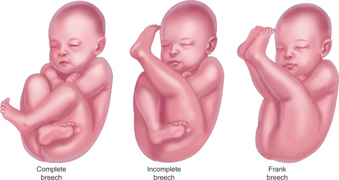 DELIVERING A BABY IN BREECH: ESSENTIAL KNOWLEDGE FOR MIDWIVES AND PARENTS