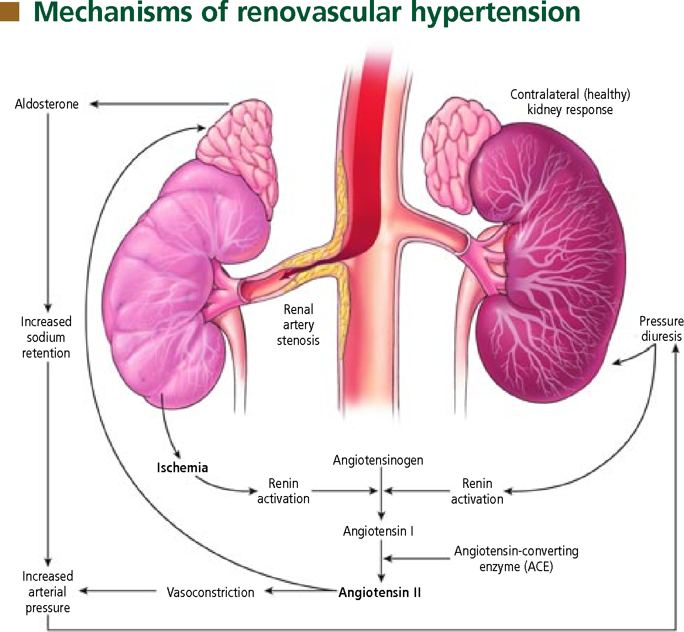 COMPREHENSIVE INSIGHTS INTO RENOVASCULAR HYPERTENSION: DIAGNOSIS AND MANAGEMENT STRATEGIES