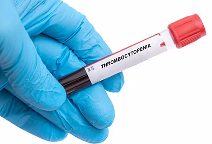 EDUCATIONAL GUIDE TO THROMBOCYTOPENIA CAUSED BY SPLENIC SEQUESTRATION: DIAGNOSIS AND CARE