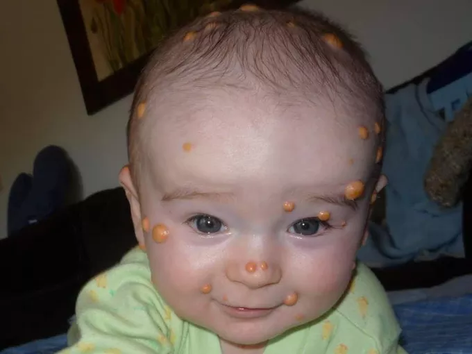 CLINICAL PERSPECTIVE ON JUVENILE XANTHOGRANULOMA: COMPREHENSIVE OVERVIEW