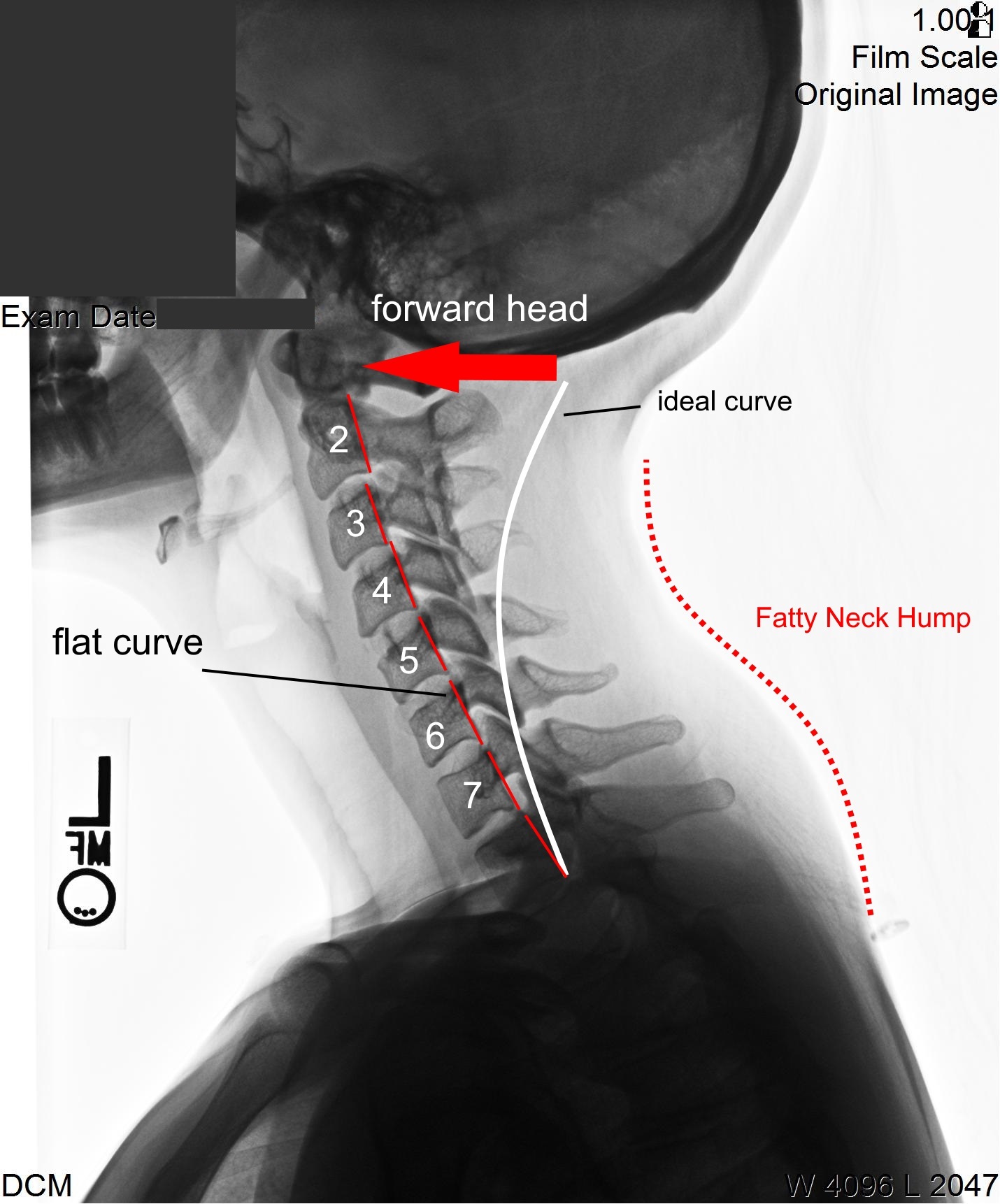 forward head posture neck hump